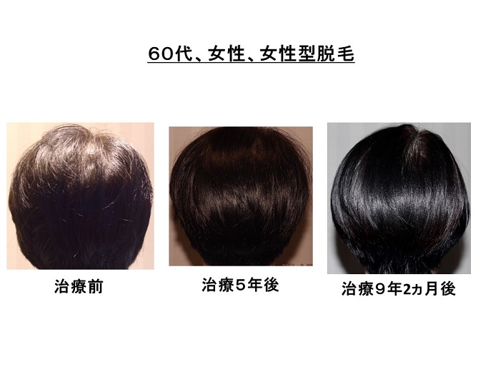 円形脱毛症　病院